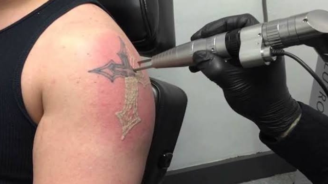 Run Coming From Skin? Make Room For Brand New Tattoos With Laser Removal